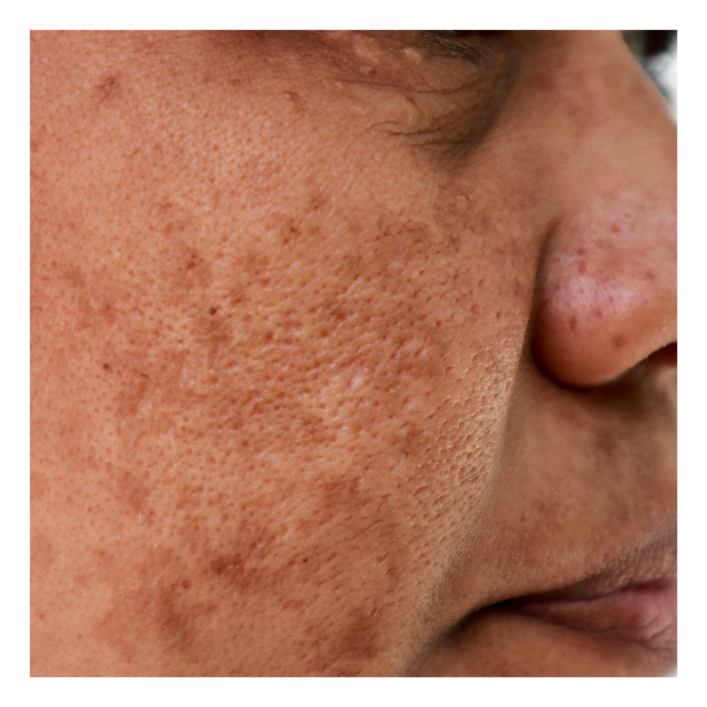 Melasma-Grau-3-25-1024×1024