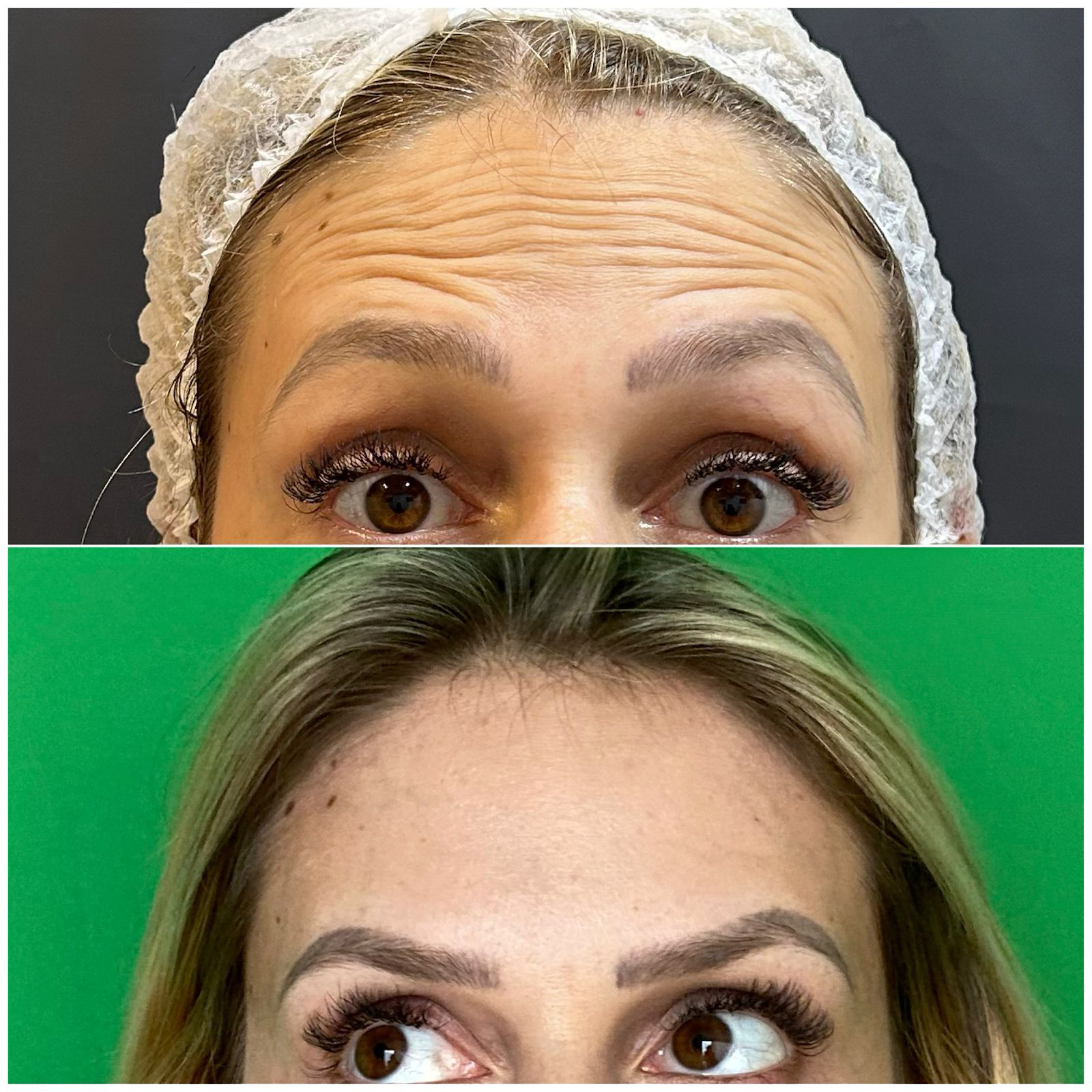 botox resultado 3